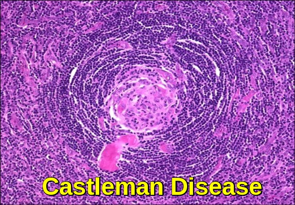 Castleman-Disease-5.jpg